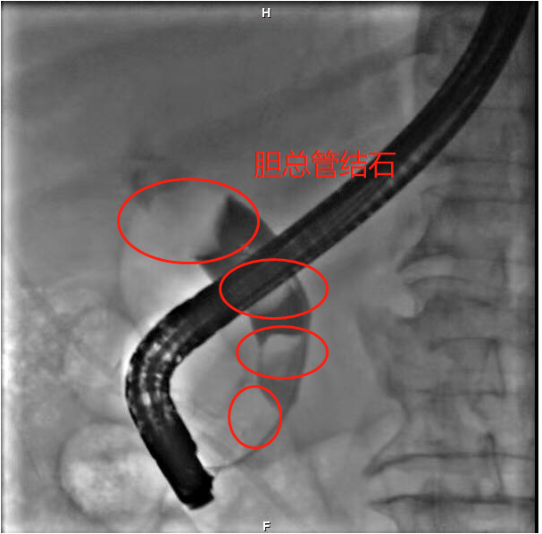 内镜下演绎外科风云ercp技术巧取胆总管巨大结石